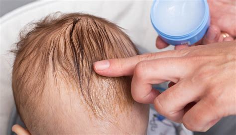 bebeklerde saç derisinde kızarıklık